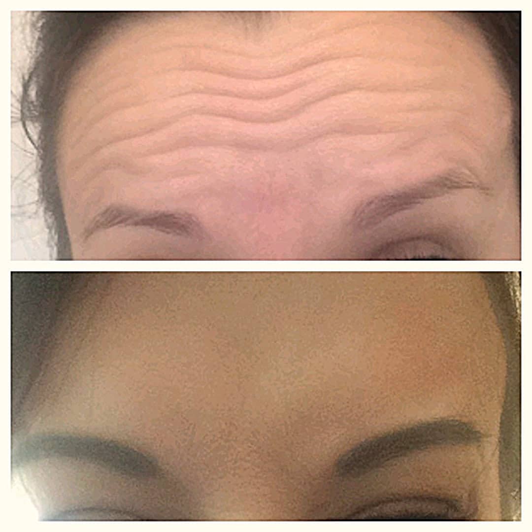 beautiful_skin_vl в LOOKY — Ваш лоб тоже может забыть о морщинах
#ботокс
#ботулинотерапи