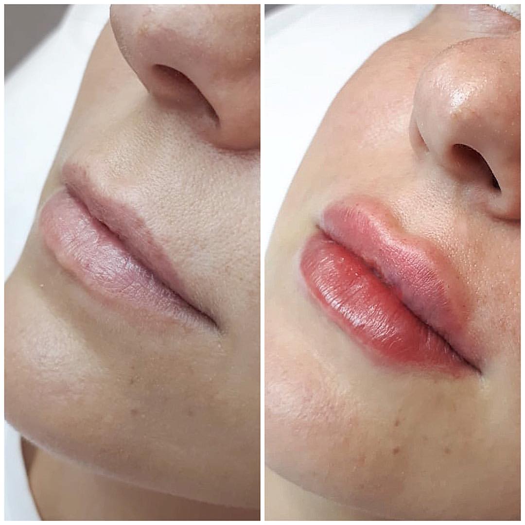 beautiful_skin_vl в LOOKY — Коррекция губ💉
Естественно и очень нежно 💕🌺
#косметолог#к