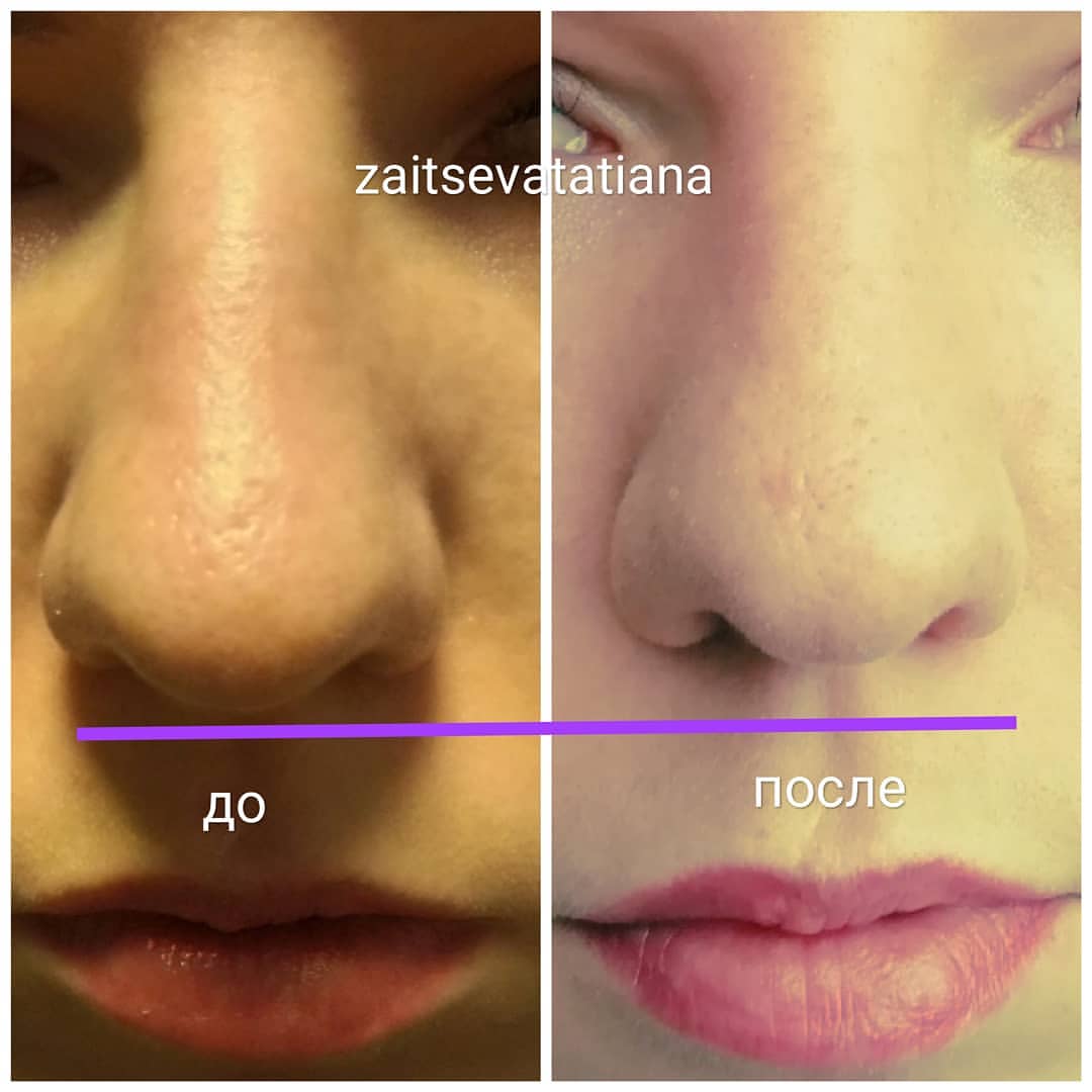 tati_cosm в LOOKY — Уменьшение носика путем введения мезококтеля. Эффект наступа