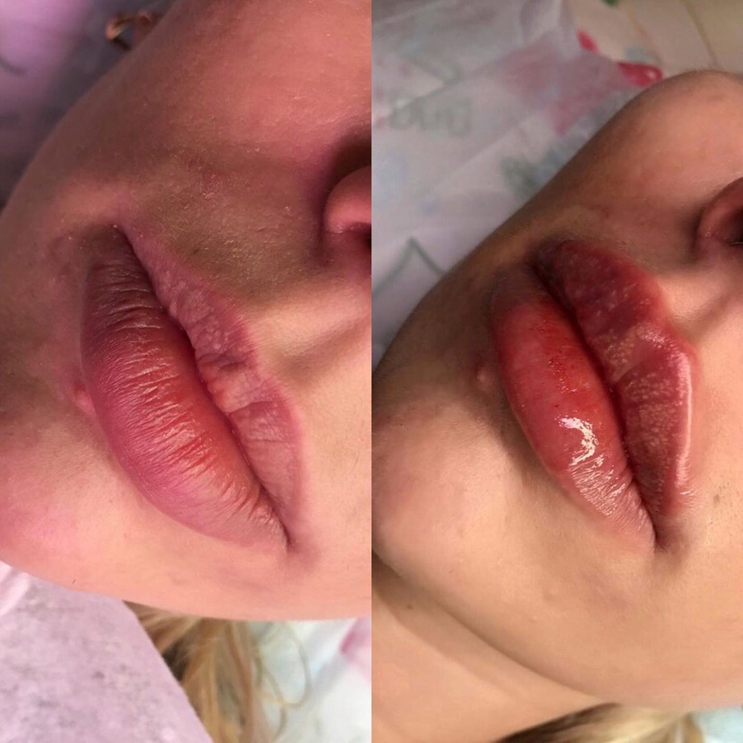 dr_volkovskaya в LOOKY — ❗️Очень сложные губы для коррекции,после неудачных попыток в