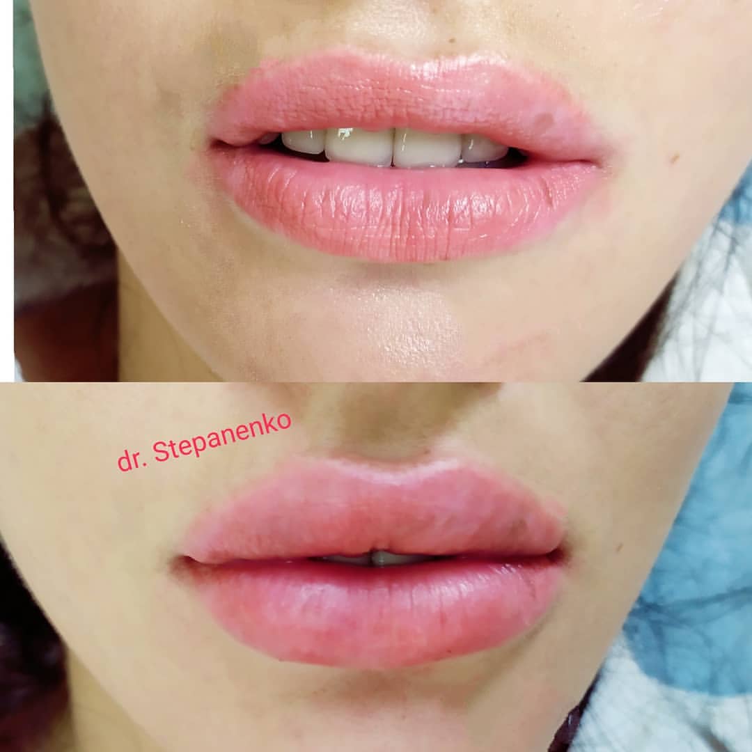 dr.stepanenko.off в LOOKY — Длительность 💉процедуры 30-40 минут состоит из:
⠀ ✅нанесени