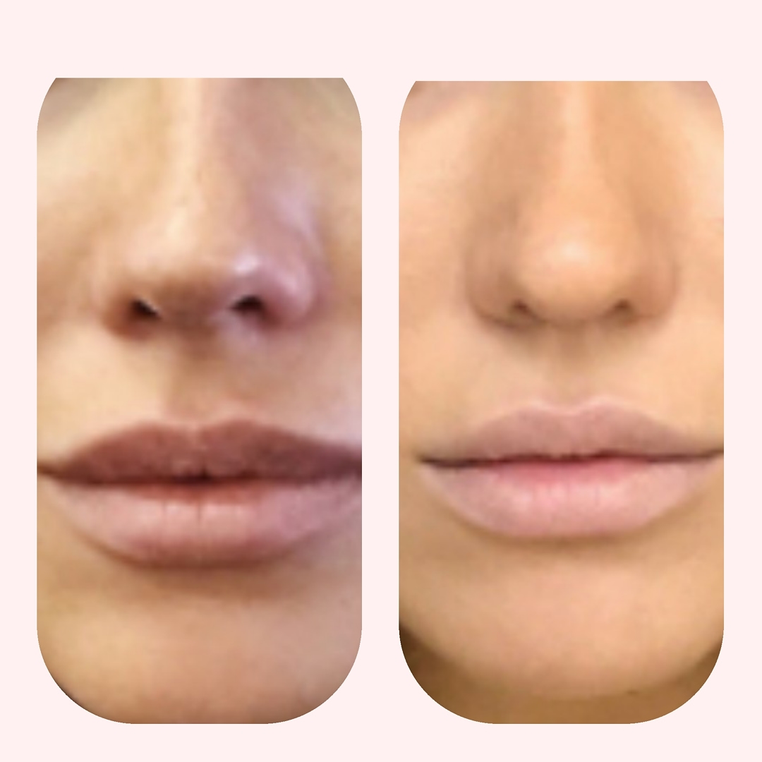 dr.lana_cosmo в LOOKY — 💉Коррекция носа при помощи липолитиков.
.
👍Результат после