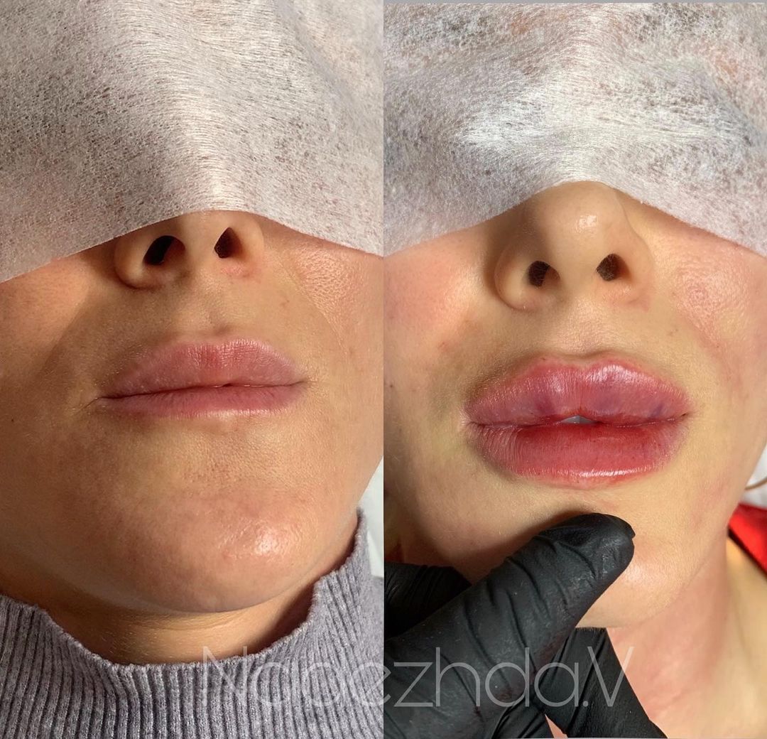 kosmetologyst__nvrs в LOOKY — Процедура коррекции губ 💉
1 мл препарата ❤️
.
✔️длительност
