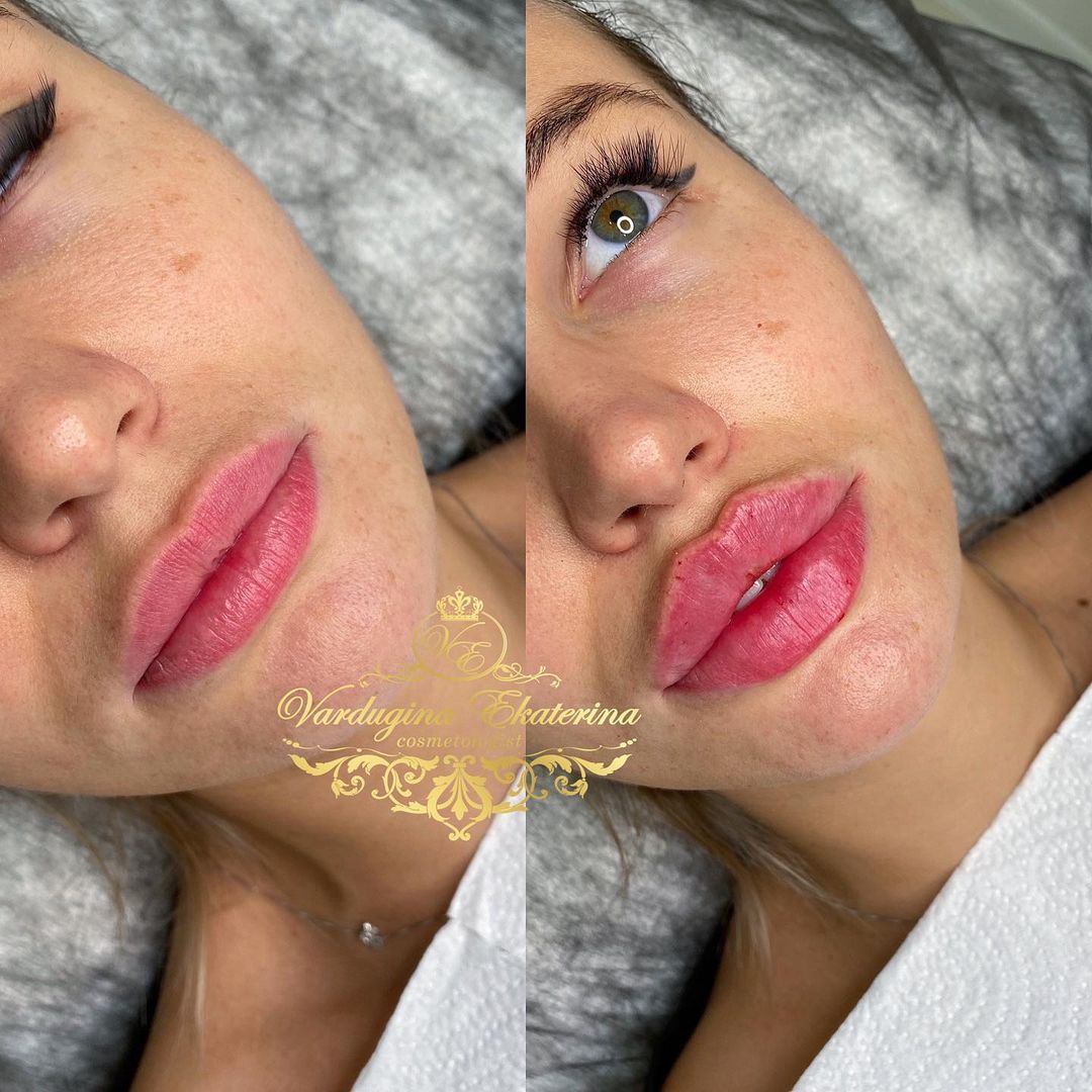 kosmetolog_katerina.v в LOOKY — Процедура коррекции губ💉
1 мл препарата❤️
✔️ Длительность п