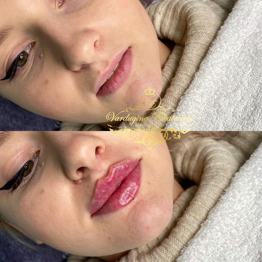 kosmetolog_katerina.v в LOOKY — Процедура коррекции губ💉
1 мл препарата❤️
✔️ Длительность п