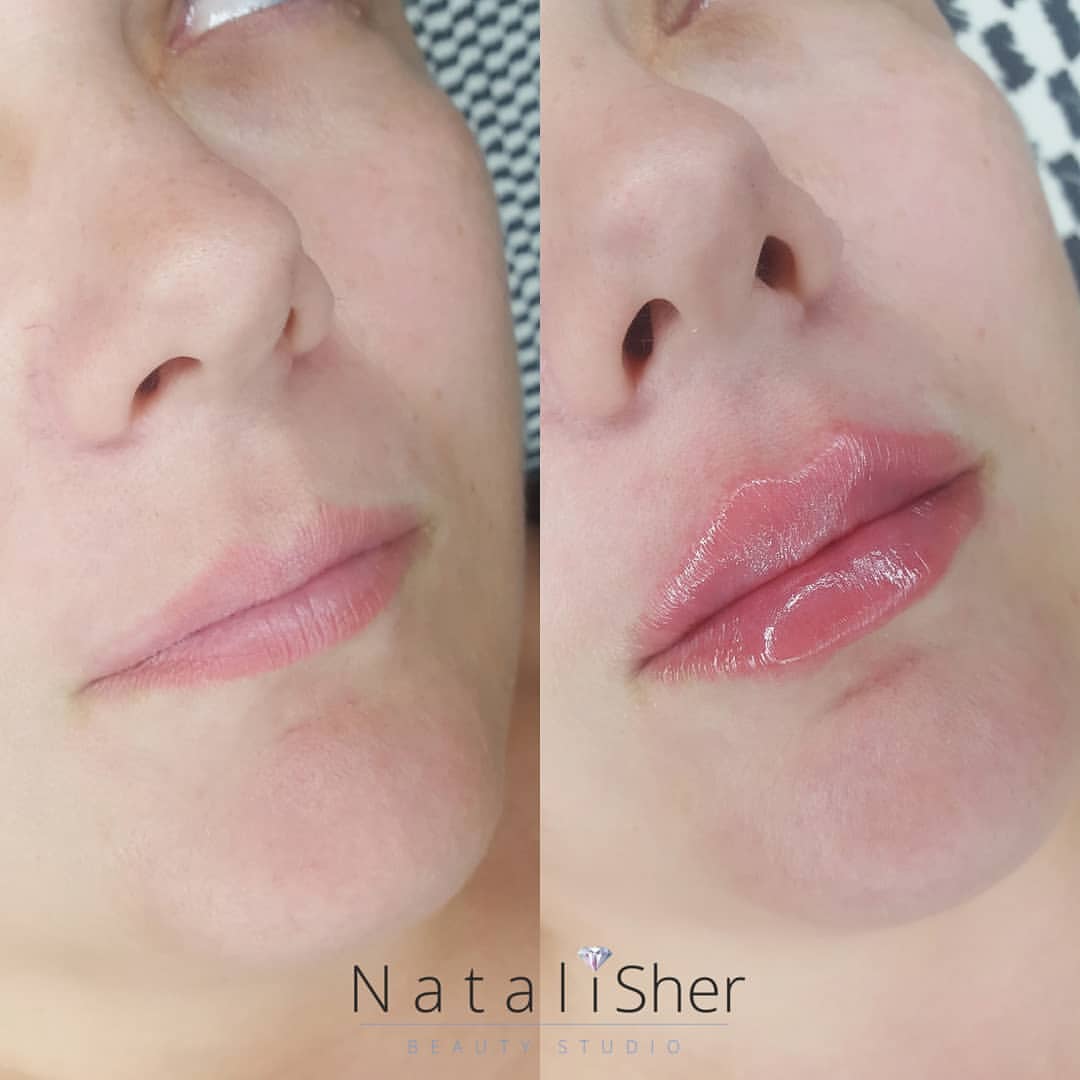 natalisher_lips в LOOKY — ОТ ЧЕГО ВЫ ИЗБАВИТЕСЬ ПОСЛЕ ПРОЦЕДУРЫ- УВЕЛИЧЕНИЕ ГУБ?
⠀
~су