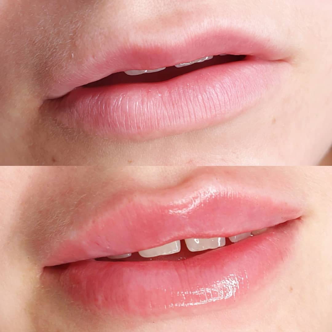 lipsstudio_ekb в LOOKY — Выравнивание формы, увлажнение, объем.
1 мл Дерсалакс Дип.💉
