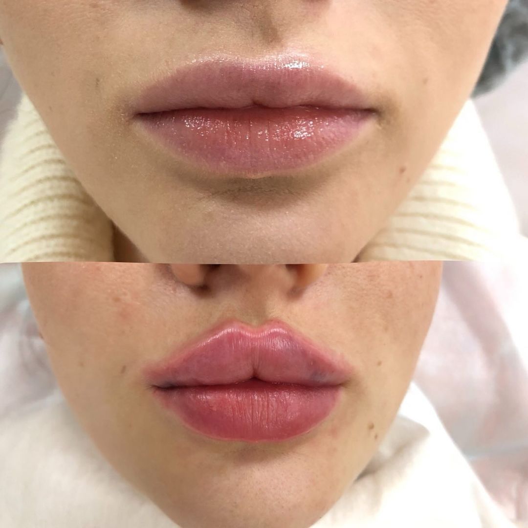 dr.sokcosmetic в LOOKY — Навели красоту с Суджидерм 30хр 💉 - 0,8 ml 👄 присутствует 