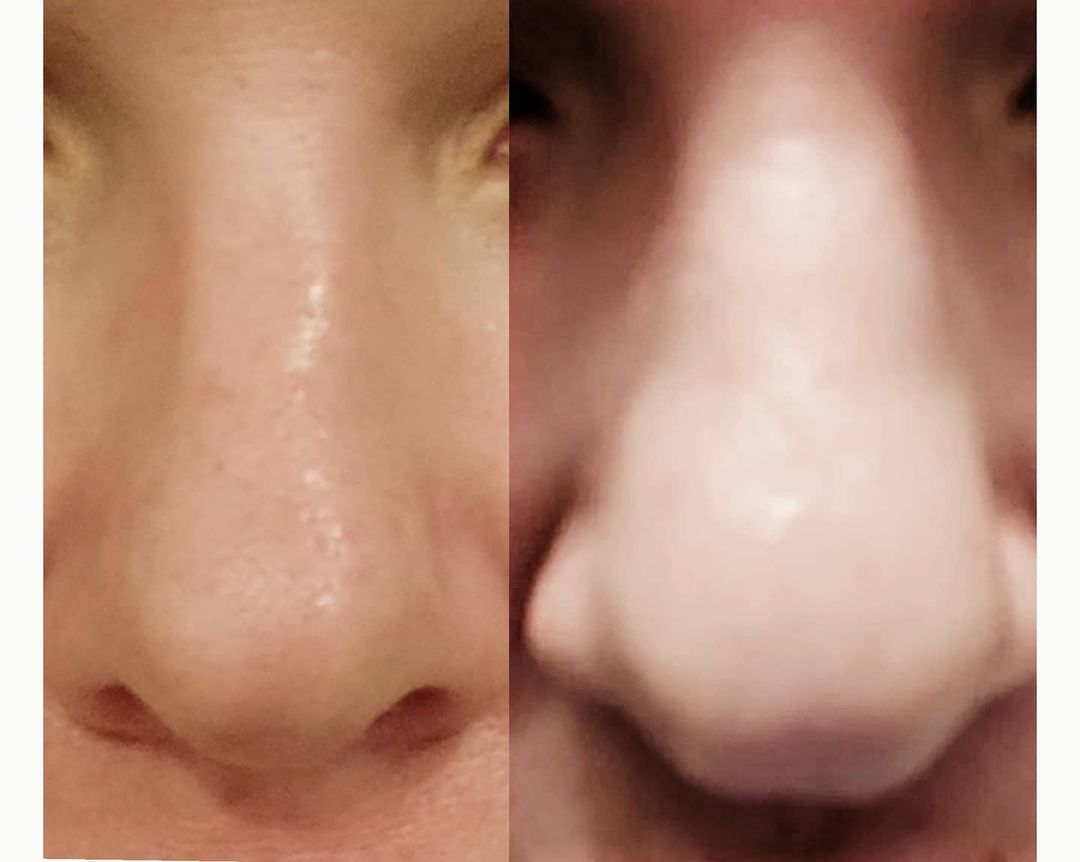 dr.lana_cosmo в LOOKY — .
🍒Проведено 2 процедуры безоперационной ринопластики.
.
👃