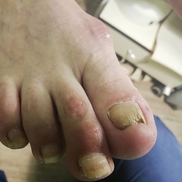 foksy_nail в LOOKY. #педикюрногинск,#маникюрногинск,#педикюрэлектросталь,#медицинский_педикюр,#подологногинск,#педикюрный_клуб_ногинск,#вросшийноготь. Медицинский педикюр ...