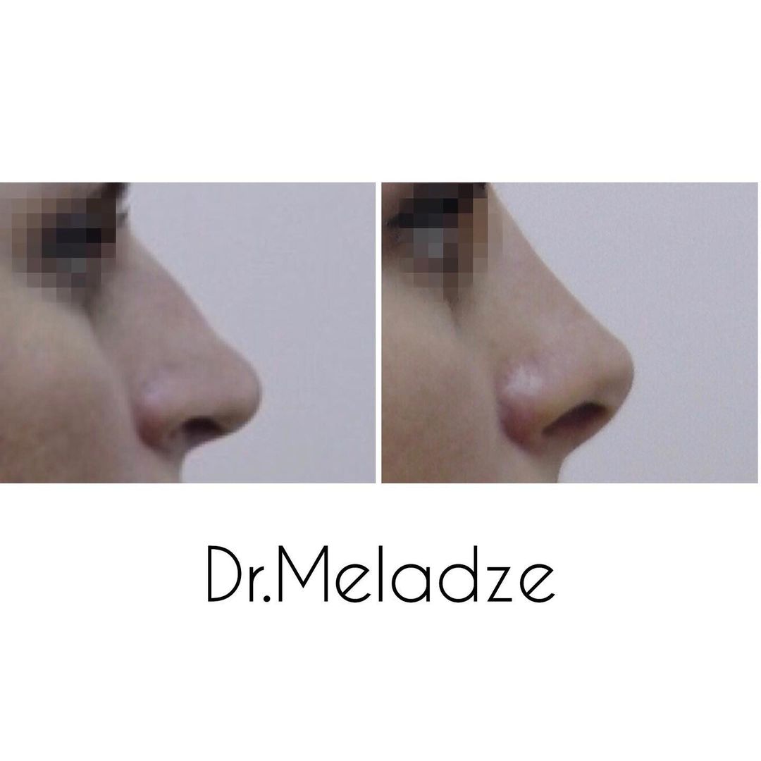 dr.meladze в LOOKY — Ринопластика👃🏻
.
2 недели поле операции✔️ наблюдается гипе