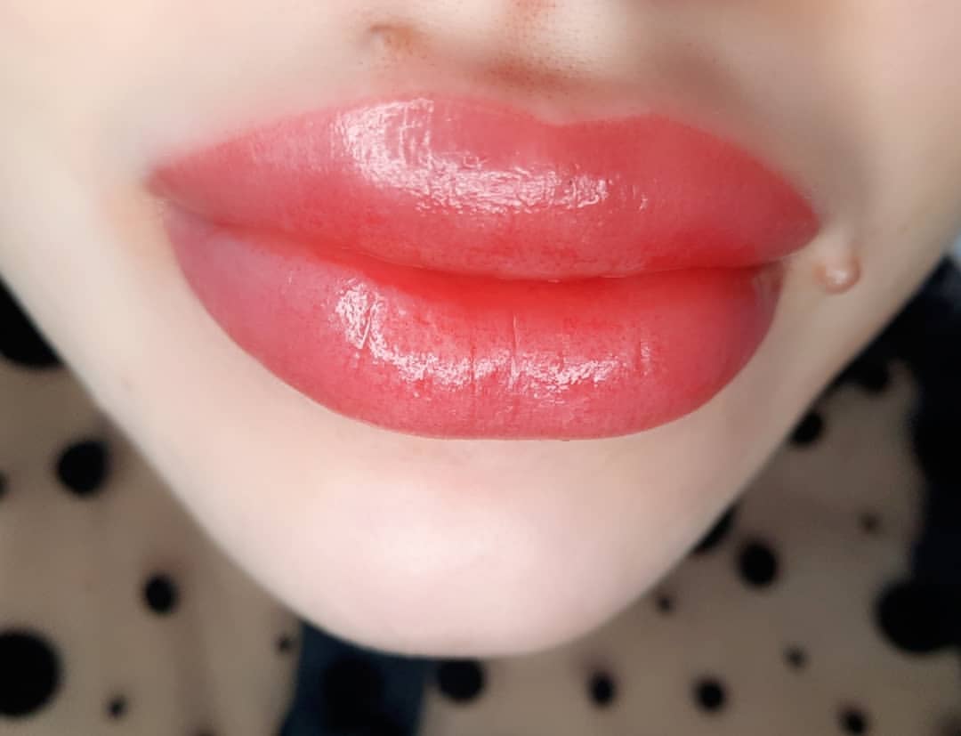 ivanovatatiana.pm в LOOKY — ГУБКИ😘😘😘
Присутствует отёк сойдет в течении нескольких ча