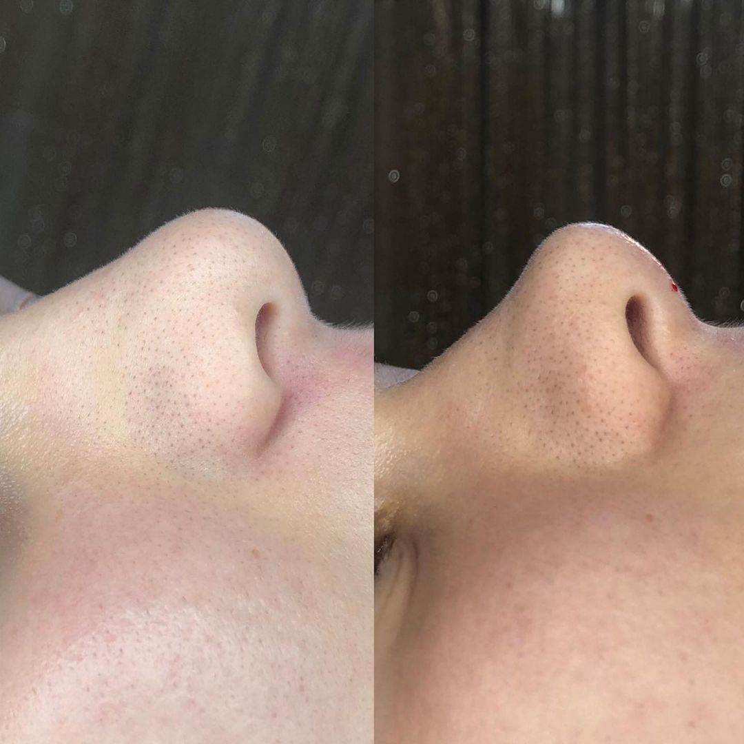 dr_cosmetolog_medzhidova в LOOKY — ❤️носики -моя любовь ❤️
Безоперационная ринопластика идеальн