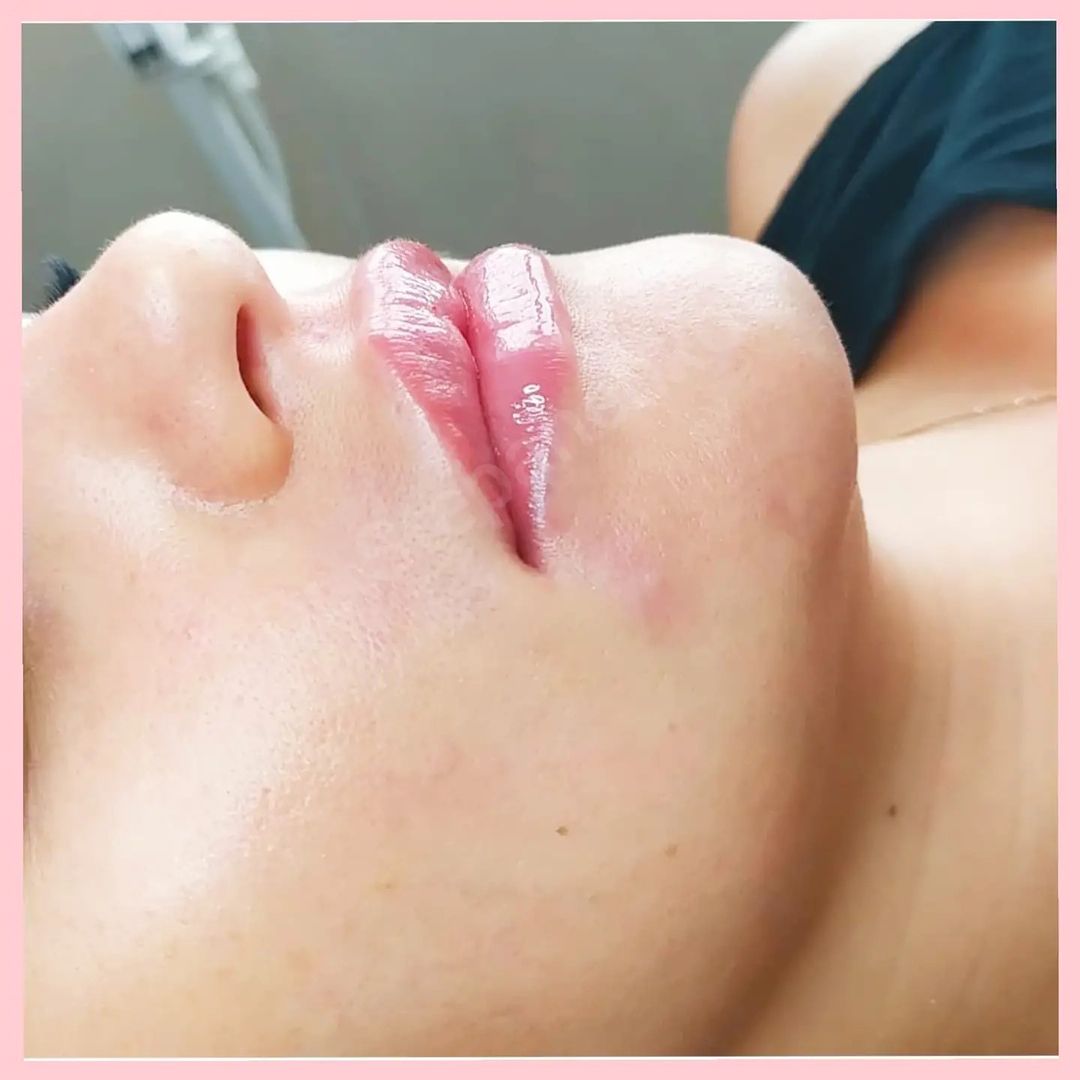 dr.stepanenko.off в LOOKY — 🌸Увеличение губ🌸 чтобы помочь исправить асимметрию / воспо