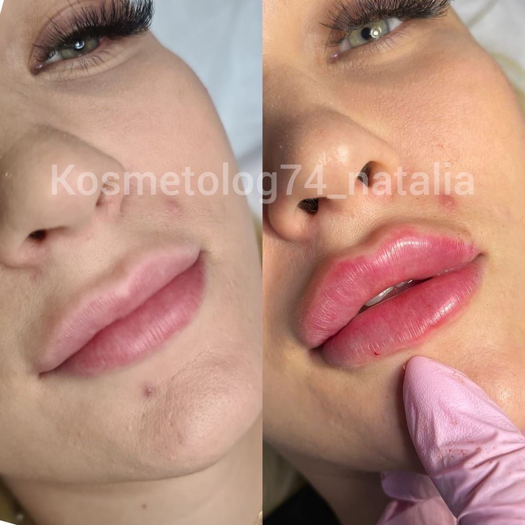 kosmetolog74_natalia в LOOKY — МИФЫ О КОНТУРНОЙ ПЛАСТИКЕ ГУБ💋
⠀
Очень уж много разных выд