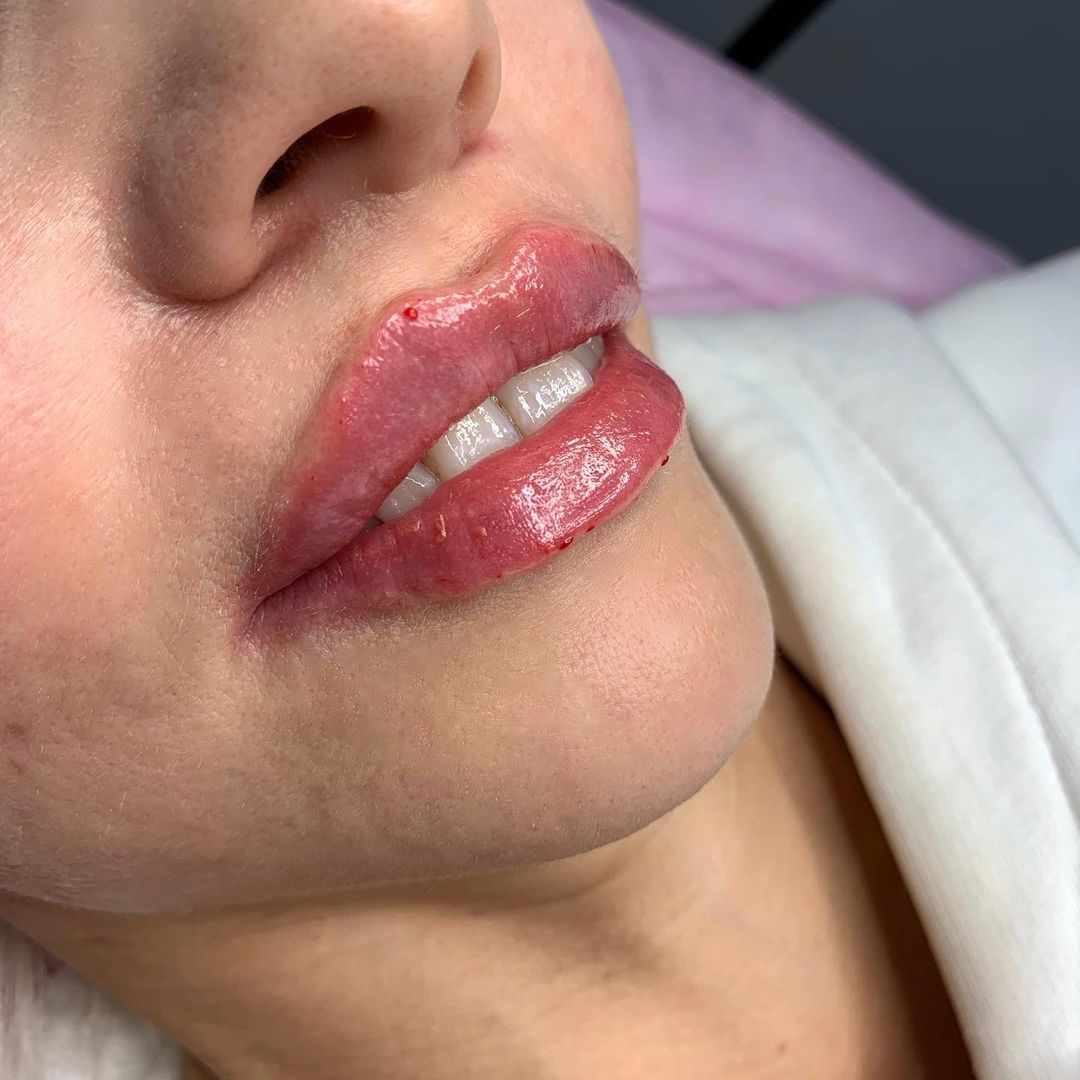 dr_volkovskaya в LOOKY — 🌟Первичное увеличение губ 
💉1 мл препарата 
#Увеличениегуб