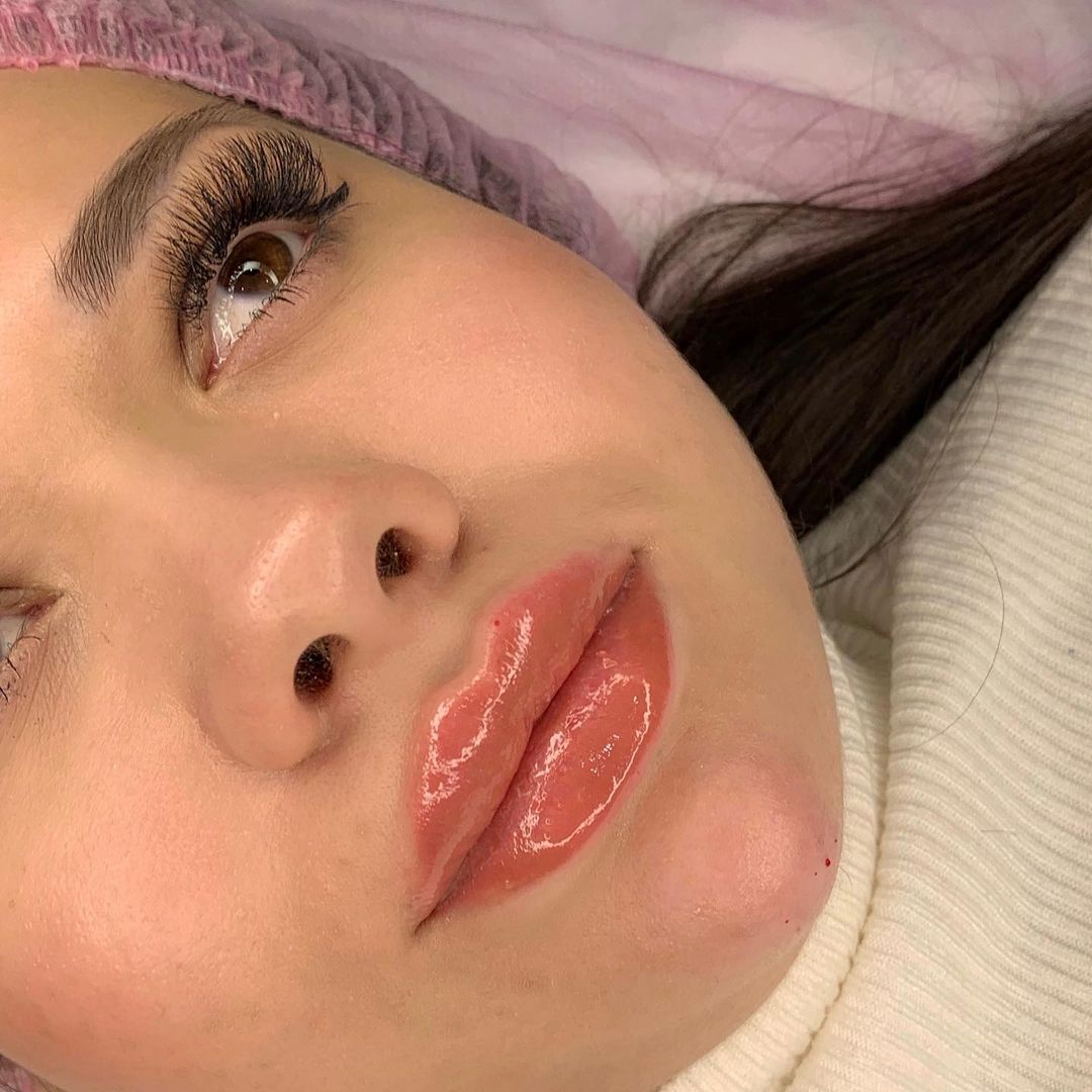 dr_volkovskaya в LOOKY — 💉Повторное Увеличение губ ❤️
✅Препарат  средней плотности 