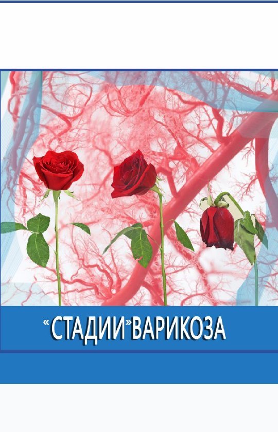 andreitempel в LOOKY. #здоровье,#красота,#гигрома,#шишка,#варикоз,#лечениеварикоза,#лазер,#эвло,#флеболог,#флебологкрасноярск,#тромбофлебит,#тромбоз,#трофическаяязва,#склеротерапия,#красноярскийкрай,#узивен,#красноярск,#кызыл,#хакасия,#эвлк,#варикозанет,#сосудистыезвездочки,#сосудистыйхирург,#крск,#врекомендации,#варикоз24,#беременностькрасноярск,#пауэрлифтинг,#абакан,#цэт. 💥Смотрите интервью ...