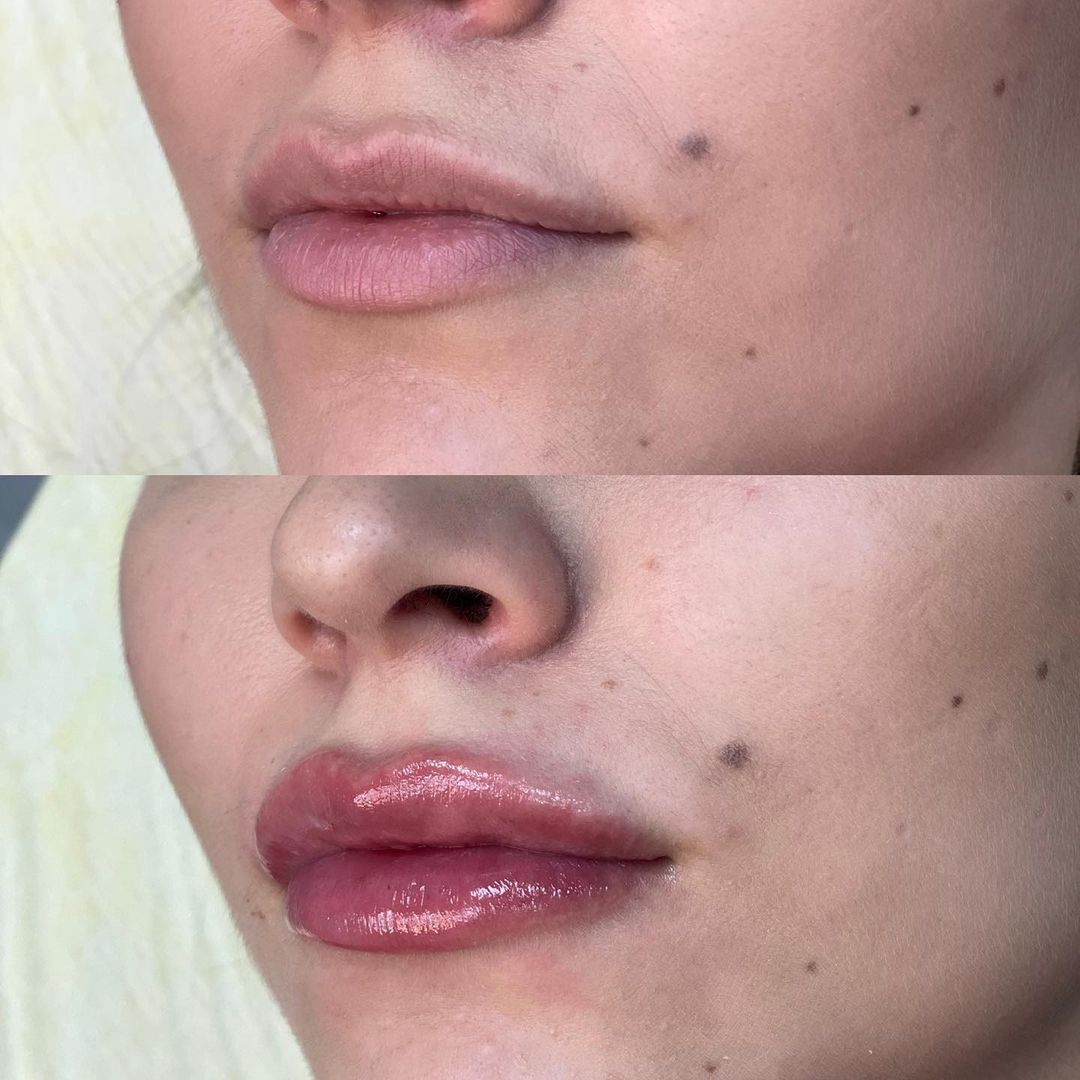 estetic_master_kzn в LOOKY — Увеличение губ может действительно изменить твою внешность в
