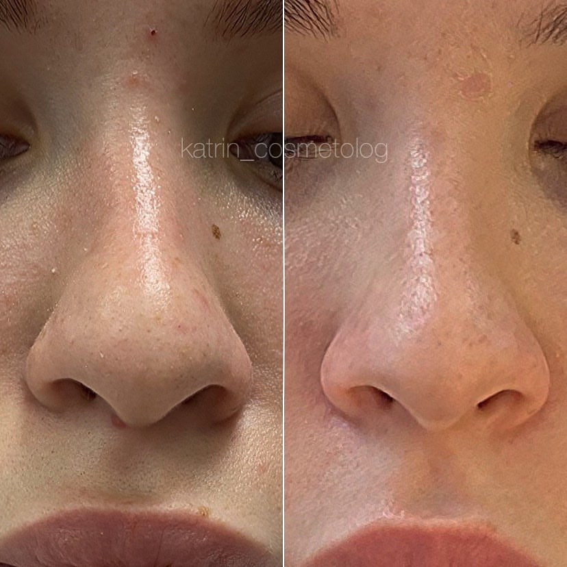 katrin_cosmetolog в LOOKY — Разница на фото в месяц. 

Работа с кончиком носа была в нес