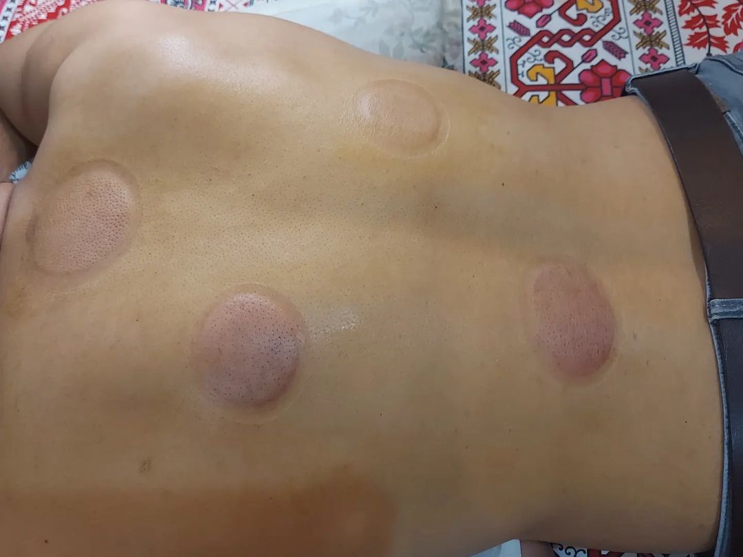 #cuppingtherapy #sunnahpoints 55no  #medication