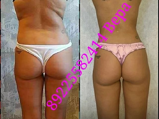 massageinoren в LOOKY. #хочупохудеть,#хочукрасивоетело,#хочумассаж,#обертываниевподарок,#выезднадом,#массажоренбург,#массаждома,#будьтездоровы,#стройнеемсверой,#ненавреди,#комплексныйподход,#всемдобра✌,#massage,#xudeem,#stroineemveselo,#anticellulite,#мед,#массажувасдома,#доипосле,#профи,#худеемсбольшихобъёмов,#похудела,#массажорен,#талия,#результат,#люблюсвоюработу,#слюбовьюотvera,#massage,#xudeem,#марафон. Девчата ! 8 сеансов ...