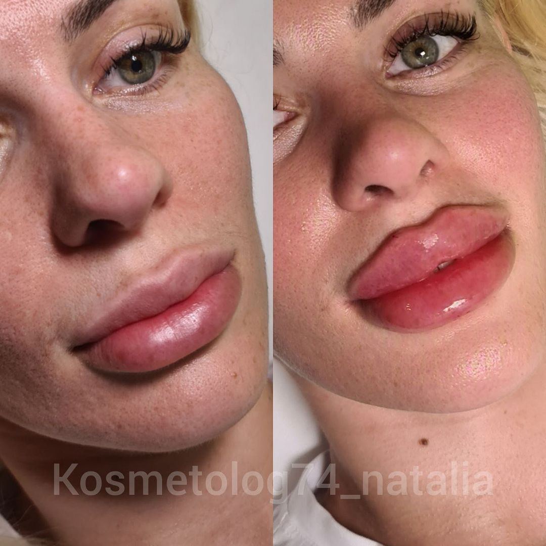 kosmetolog74_natalia в LOOKY — АУГМЕНТАЦИЯ ГУБ✔️

Такая процедура как увеличение губ пользу