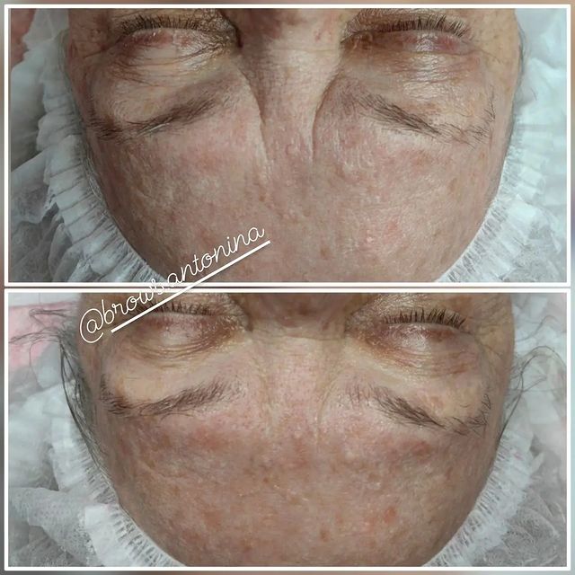 antonina.cosmetologist в LOOKY. #красотабезуколов,#краснодар,#крд,#светлоград,#смр,#косметология,#массажлица. Результаты "до/после...