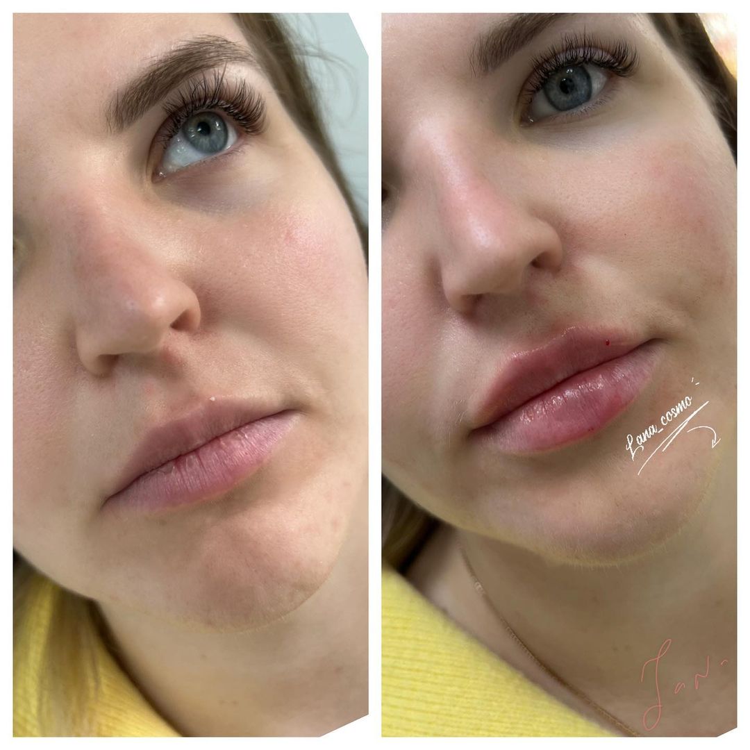 dr.lana_cosmo в LOOKY — Увеличение губ 💋
 
В губах 1,1 мл  препарата ГК.
 
✔Длитель
