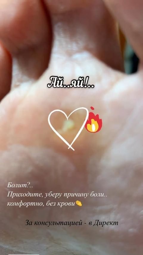 podopedicure_savranskayaa в LOOKY. #стержневаямозоль,#подологическийпедикюр,#подологнижнекамск,#мозолинастопе,#мозолинапальцах,#трещинынапятках,#гигиеническийпедикюр,#мужскойпедикюрнижнекамск,#подологнадом. Больно не будет!..эт...