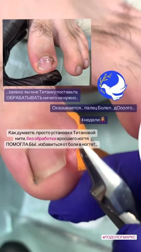 podopedicure_savranskayaa в LOOKY. #вросшиеногти,#нижнекамскпедикюр,#подологнадом,#подологнижнекамск,#парамедицинскийпедикюр,#подологнк,#небольносовсем,#педикюрпожилым,#подростковаямода,#reelsvideo. "Выхода нет только и...