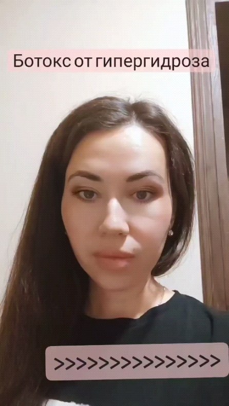 almira_atabayeva в LOOKY. #гипергидроз,#лечениепотливости,#косметологташкент,#бта,#ботокс. #гипергидроз #лечени...