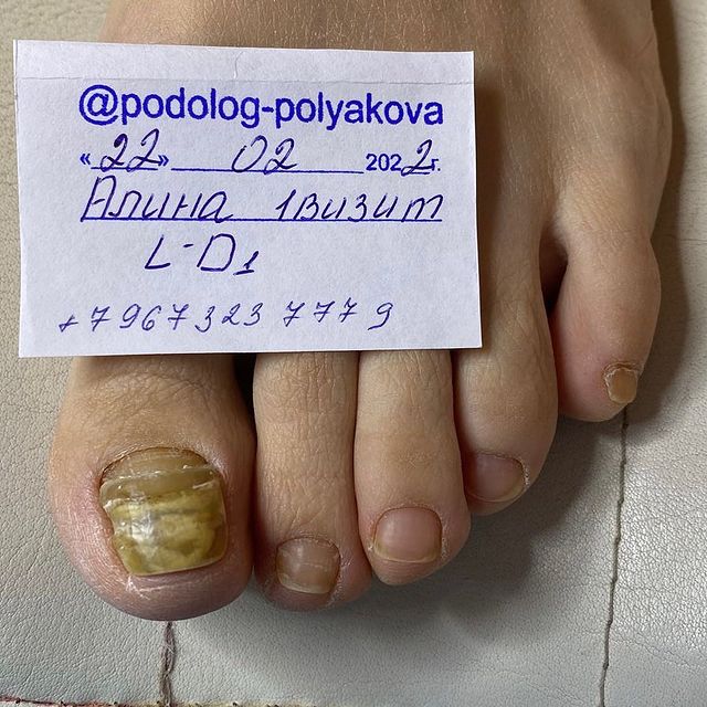 podolog_polyakova в LOOKY. #полноевосстановлениеногтей,#подология,#подологсочи. Вместо слов, просто ...