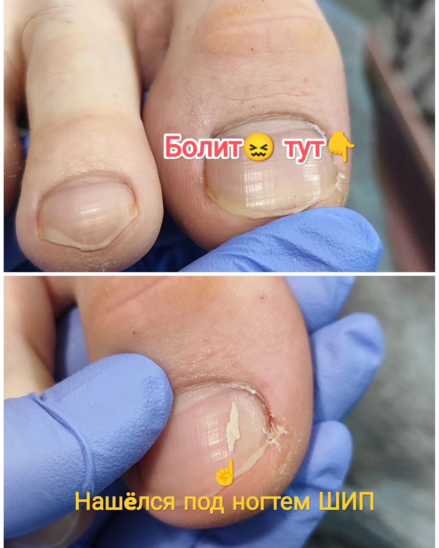 podopedicure_savranskayaa в LOOKY. #парамедицинскийпедикюр,#подологическийпедикюр,#вростаетноготь,#подологнижнекамск,#татарстан,#кабинетподолога,#педикюрнк,#аппаратныйпедикюр,#смартпедикюрчелны,#нижнекамсконлайн. Вот люблю я таких лю...