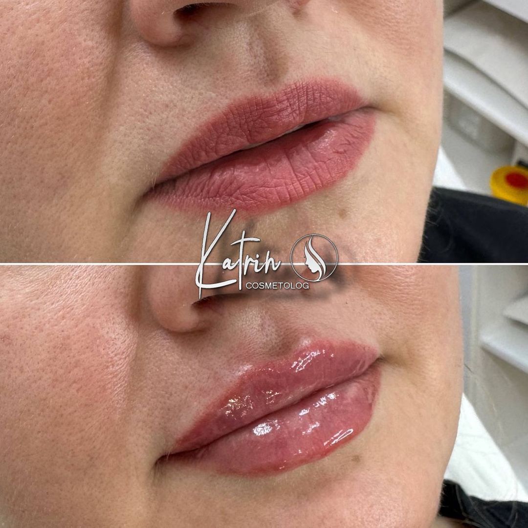 katrin_cosmetolog в LOOKY — Подробно об увеличении губ. 

Плюсов процедуры увеличения гу