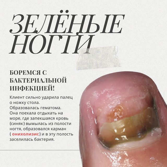 mama_karlo_nogti в LOOKY. #маникюрмосква,#зеленоградманикюр,#маникюрзеленоград,#обучениеманикюр,#маникюробучение,#маникюрпошагам,#повышениеквалификации,#мастерманикюра,#ногтевойсервис,#трендыманикюра,#новыетехникиманикюра,#маникюр,#мастерманикюра,#техникиманикюра,#идеальныеногти,#советыпоманикюру,#ногтиинфекция,#pseudomonasaeruginosa. Боремся с бактериаль...