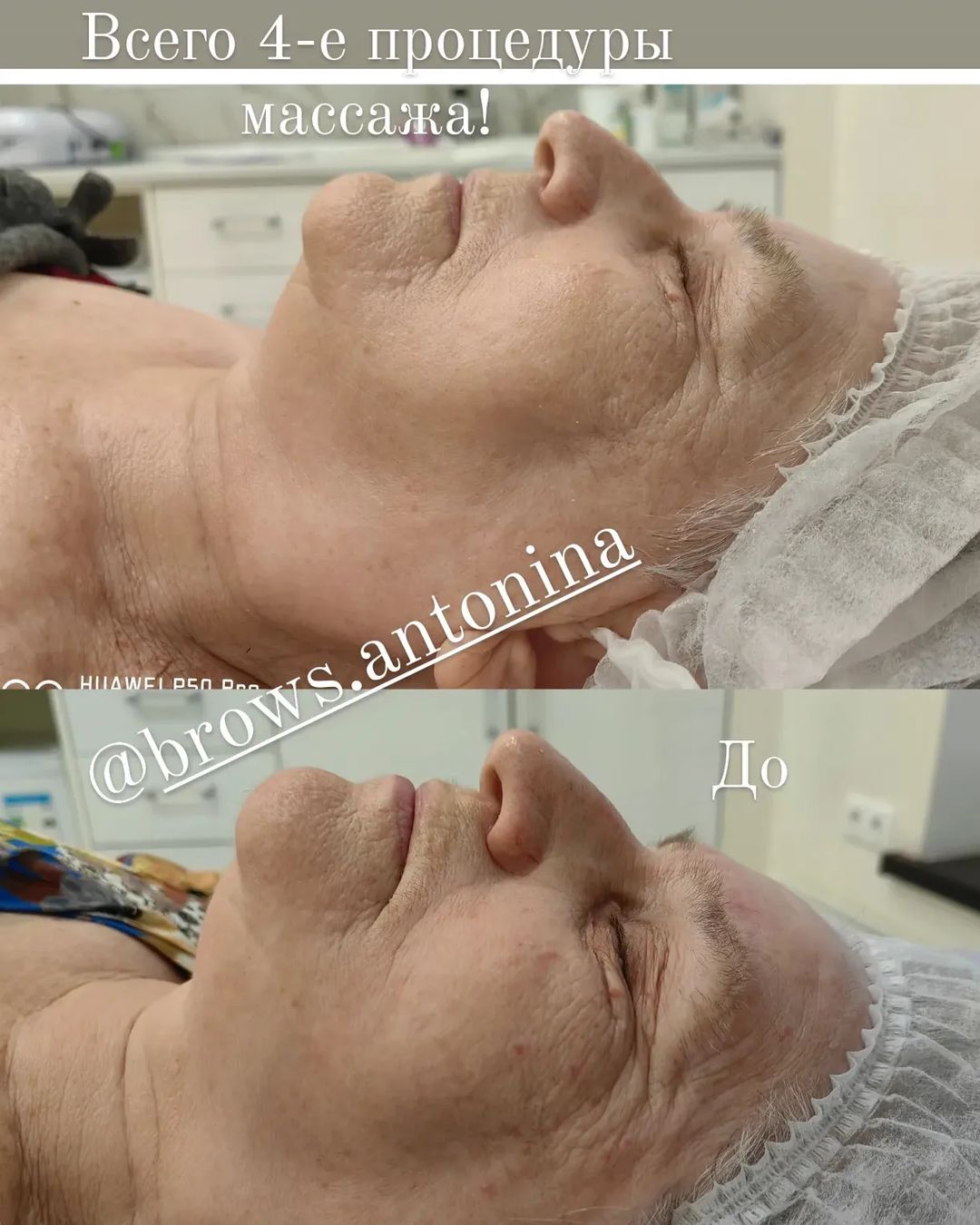 antonina.cosmetologist в LOOKY — Рекомендуемый курс от 10 процедур.
Но изменения Вы заметите 