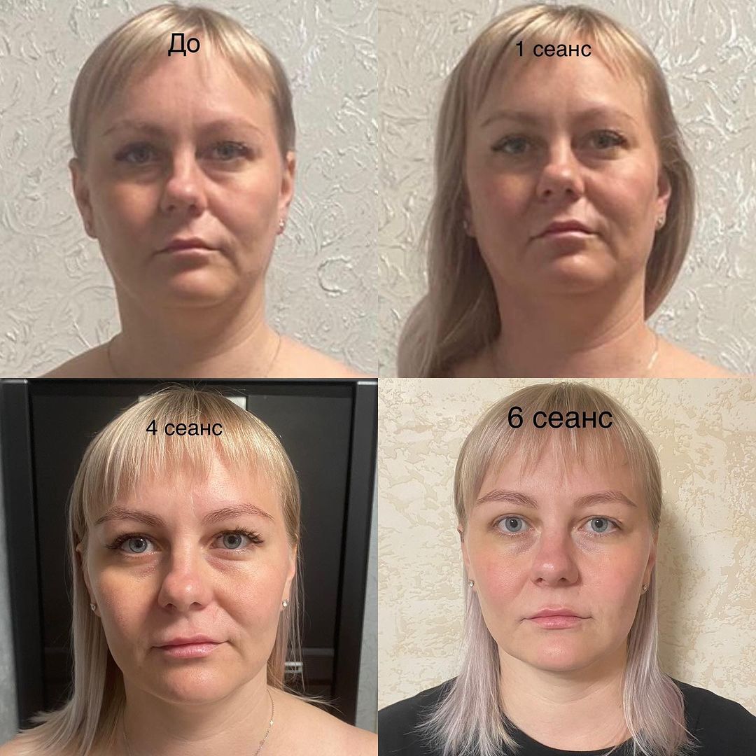 ПРОМЕЖУТОЧНЫЙ РЕЗУЛЬТАТ!!!

У неё на лице всё написано!!! ( есть такое выражение и оно мне очень нравится🩶)

В течении 2 месяцев сделали 6 сеансов!!!

Жалобы были такие: стресс, депрессия, боли в спине, боли в желудке!!! ГАЙМОРИТ!!!

Она летит на приём и готова лежать хоть 3 часа😃За что я ей очень благодарна🙏

Следите за своим здоровьем - за телом и душой!!! 
Нам оно всегда всё показывает и рассказывает!!! 
Болезнь это БЛАГО!!!

Посмотрите как меняется лицо, когда работаем  с телом и головой!!!

Правда же стала на несколько лет моложе?

Ps: нависшее веко тоже поднимется , дело времени🙏