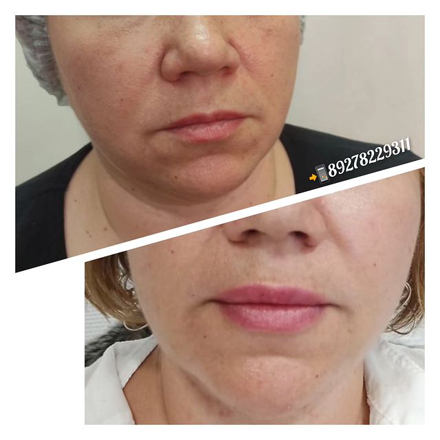 kosmetolog_permanent_ulyanovsk в LOOKY. #бьютификацию,#работаюкосметологом. Поделюсь с вами пром...