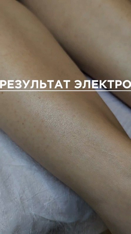 epil.lyasya в LOOKY. #электроэпиляция,#электрочелябинск,#ээЧелябинск,#электрожаиляциячелябинск. Начни прямо сейчас, ...