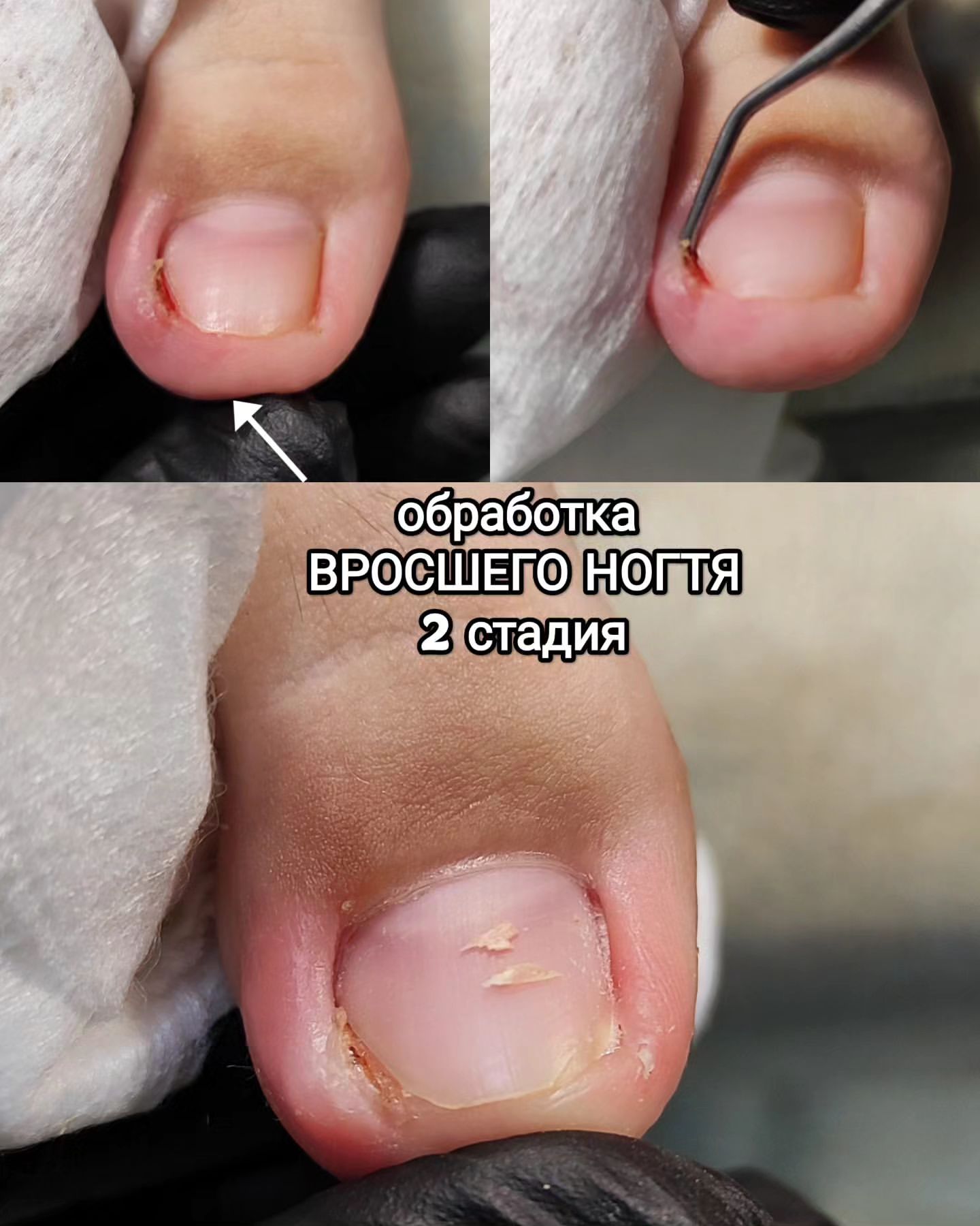 podopedicure_savranskayaa в LOOKY. . Обработка вросшего н...