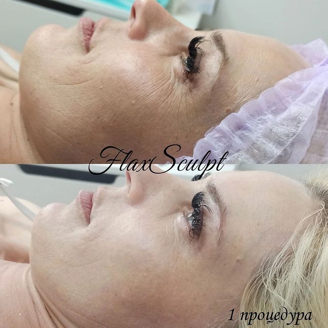 milavetrova_flax в LOOKY. #салоныкрасоты,#чисткалица,#новороссийск,#анапа,#косметологанапа,#омоложение,#flaxlift,#FlaxTap,#FlaxSculpt,#безуколов,#flax,#flaxanapa,#обучениеонлайн,#обучениекосметологов,#обучениевизажистов,#краснодар. Новое направление в ...