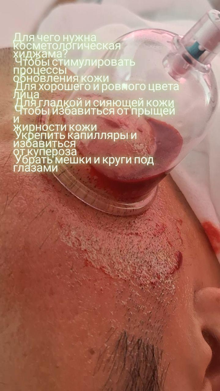 dushanbe.hijama в LOOKY. . Косметологическая хи...