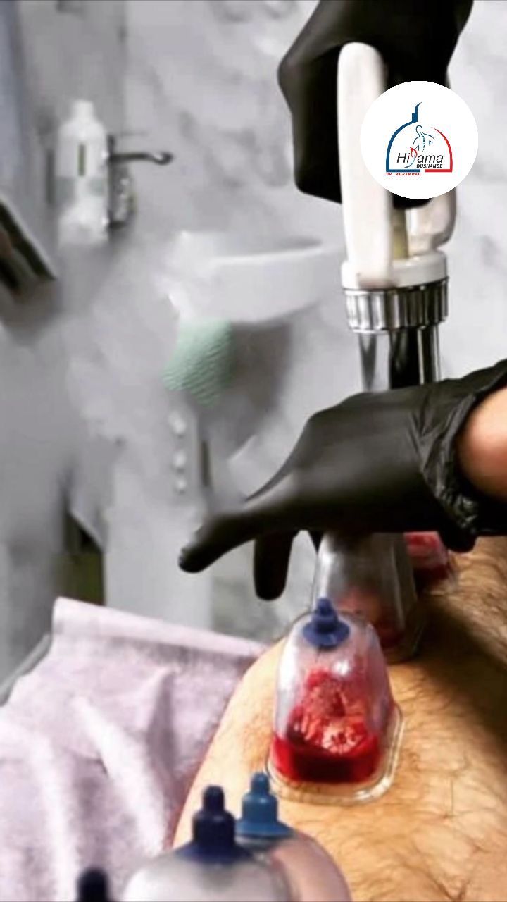dushanbe.hijama в LOOKY. . Хиджама прочищает ар...