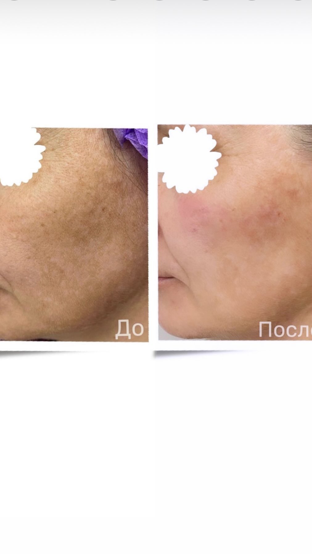cosm_hadi в LOOKY. #pilingi,#пилинг,#чисткалица,#красота,#косметолог,#косметология,#массажлица,#косметика,#биоревитализация,#омоложение,#уходзалицом,#здоровье,#уход,#маска,#мезотерапия,#уходзакожей,#пилинглица,#ботокс,#дарсонваль,#патчи,#скраб,#карбокситерапия,#лифтинг,#брови,#гель,#гиалуроноваякислота,#губы,#reelsinstagram. Кожа травмируется во...
