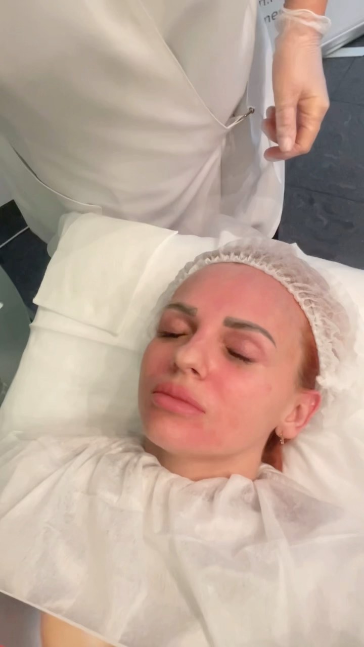 cosmetologmarkelova в LOOKY. #пилинг,#пилингджесснера,#ретиноловыйпилинг,#rfлифтинг,#карбокситерапия,#косметологрудакова,#карбокситерапияодинцово,#карбоксиодинцово,#nizar,#uton,#инъекционнаякарбокситерапия,#плазмотерапияодинцово,#плазмолифтинг,#плазмотерапия,#косметологрудакова,#косметологияодинцово,#филлеродинцово,#juvederm,#botoxface,#ботоксодинцово,#тредлифтингодинцово,#нитивойлифтинг. Сезон пилингов объяв...
