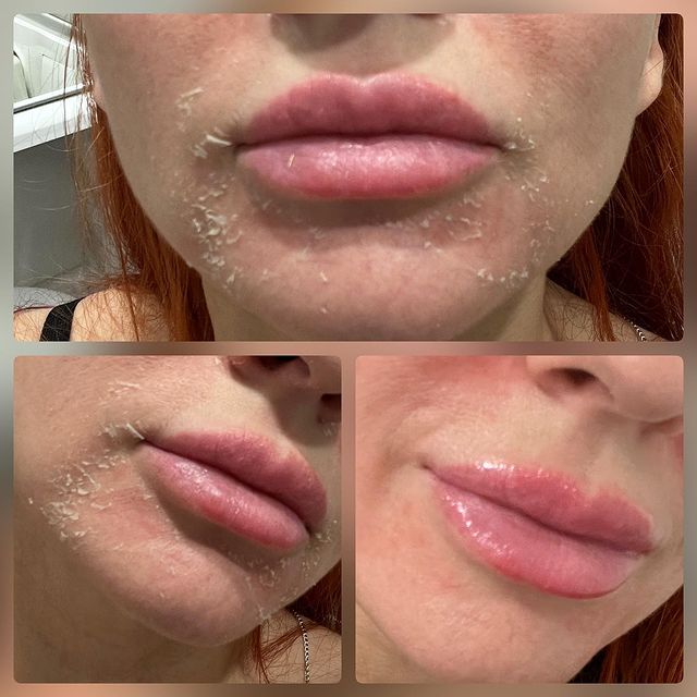 cosmetologmarkelova в LOOKY. #постпилинговыйуход. 2 день после пилинга...