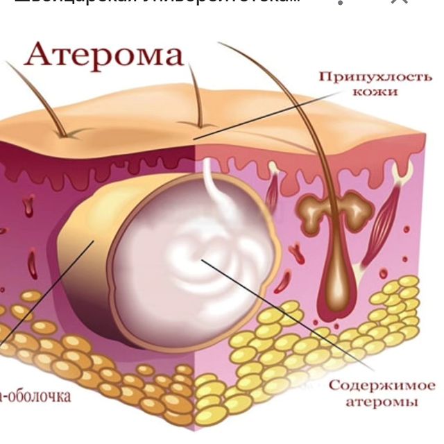 dr.miskaryan в LOOKY. #больвухе,#операциинаухе,#атерома,#атеромауха. - "У меня на ухе шиш...