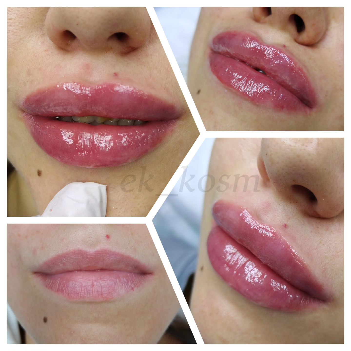 ek.kosm в LOOKY. #косметологияянтарный,#красивыйбукетянтарный,#красивыегубкиянтарный,#массажlpgянтарный,#анализысоскидкой,#карбокситерапияянтарный,#нутрициологянтарный,#диетаипитание,#лазернаяэпиляциябалашиха,#восточный,#изумрудный,#янтарный,#солярийянтарный,#ботоксянтарный. Давно не вела инстаг...