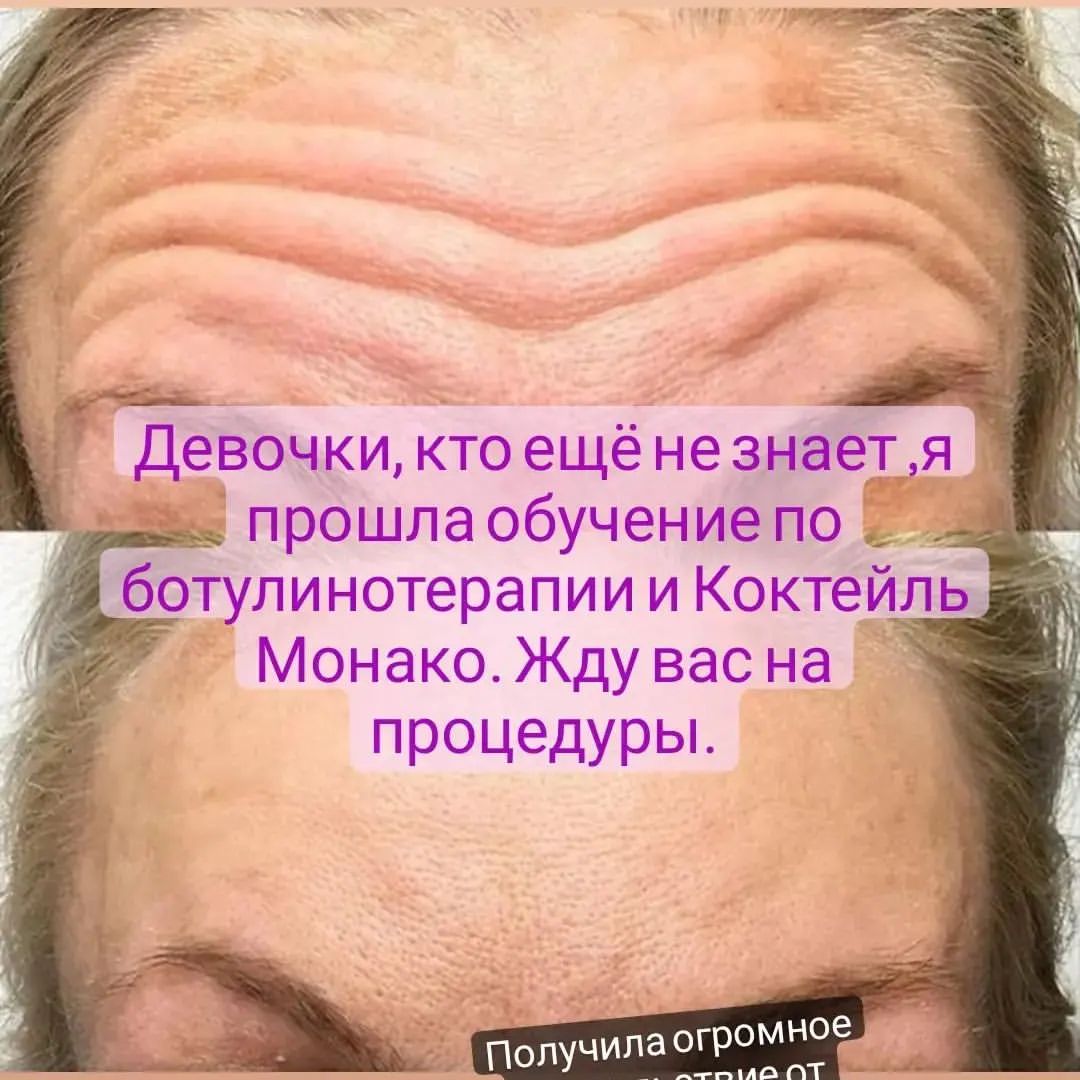 m_cosmetolog.vlg в LOOKY. #ботокс,#красота,#кометологволгоград. Ботулотоксин, избави...